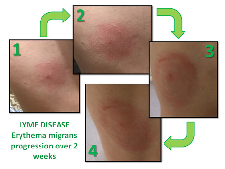 lyme-disease-rash-progression | On Landscape